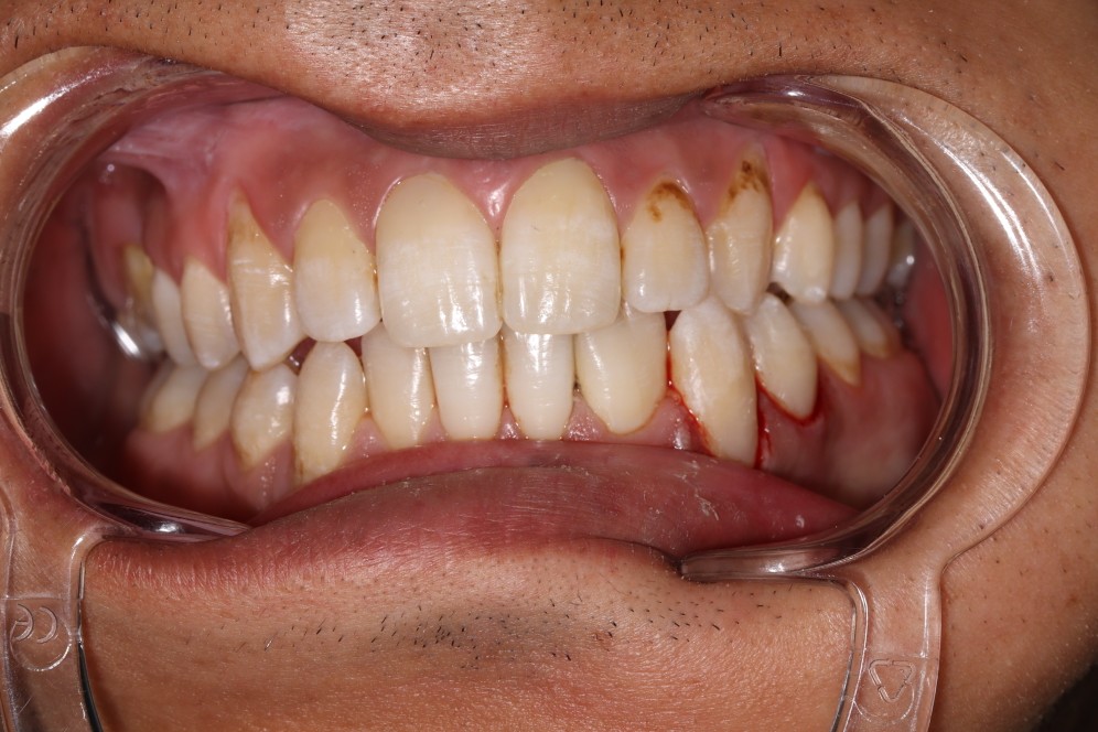 Photo après l'intervention